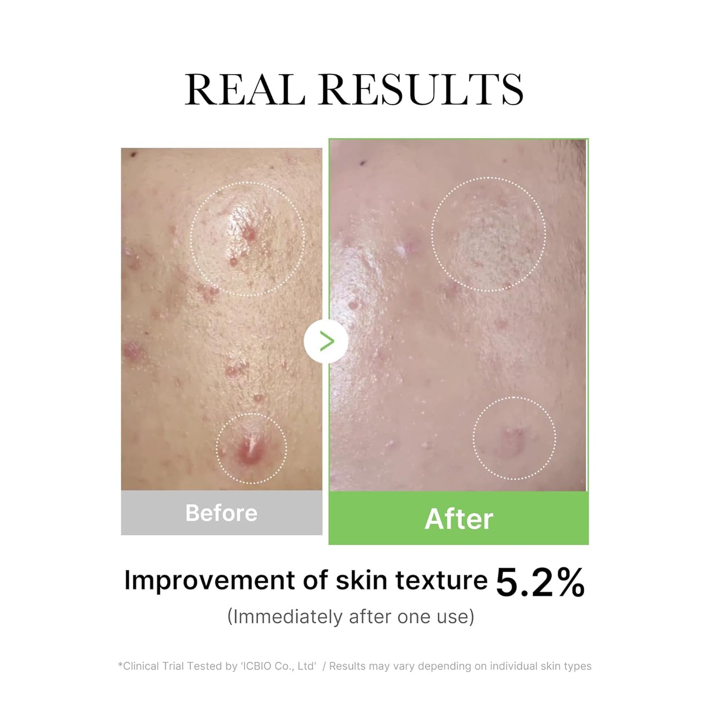 Medicube Exosome Cica Tea Tree Ampoule | Sensitive Skin Calming Serum with Centella & Tea Tree | Soothing, Hydrating, Redness Care | 30ml - T.E.R